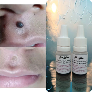 قطره خال بر (خال گوشتی . میخچه . زگیل )